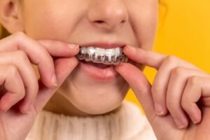 ClearAligners